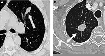 Use of fractals in determining the malignancy degree of lung nodules